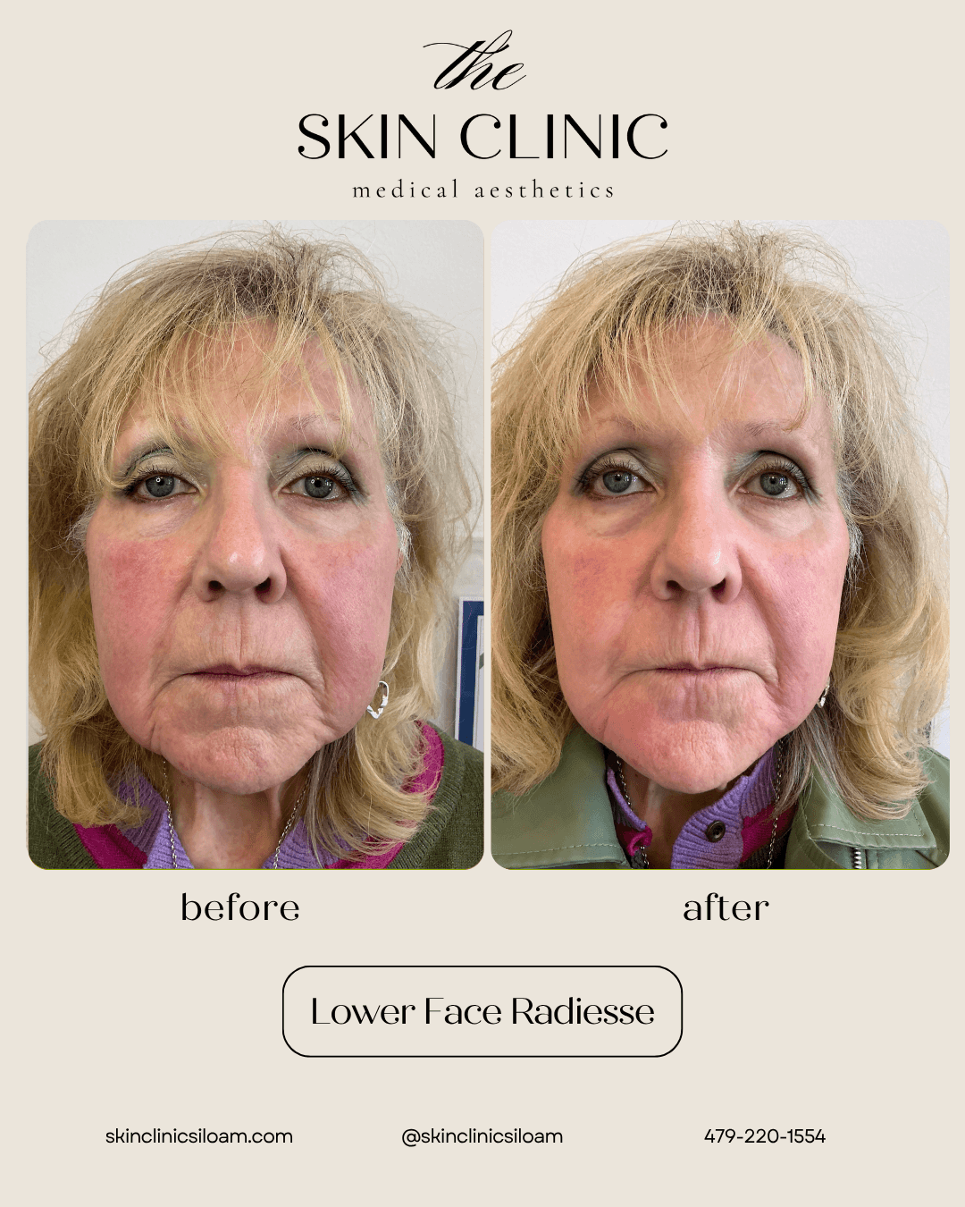 Lower Face Radiesse - Before & After