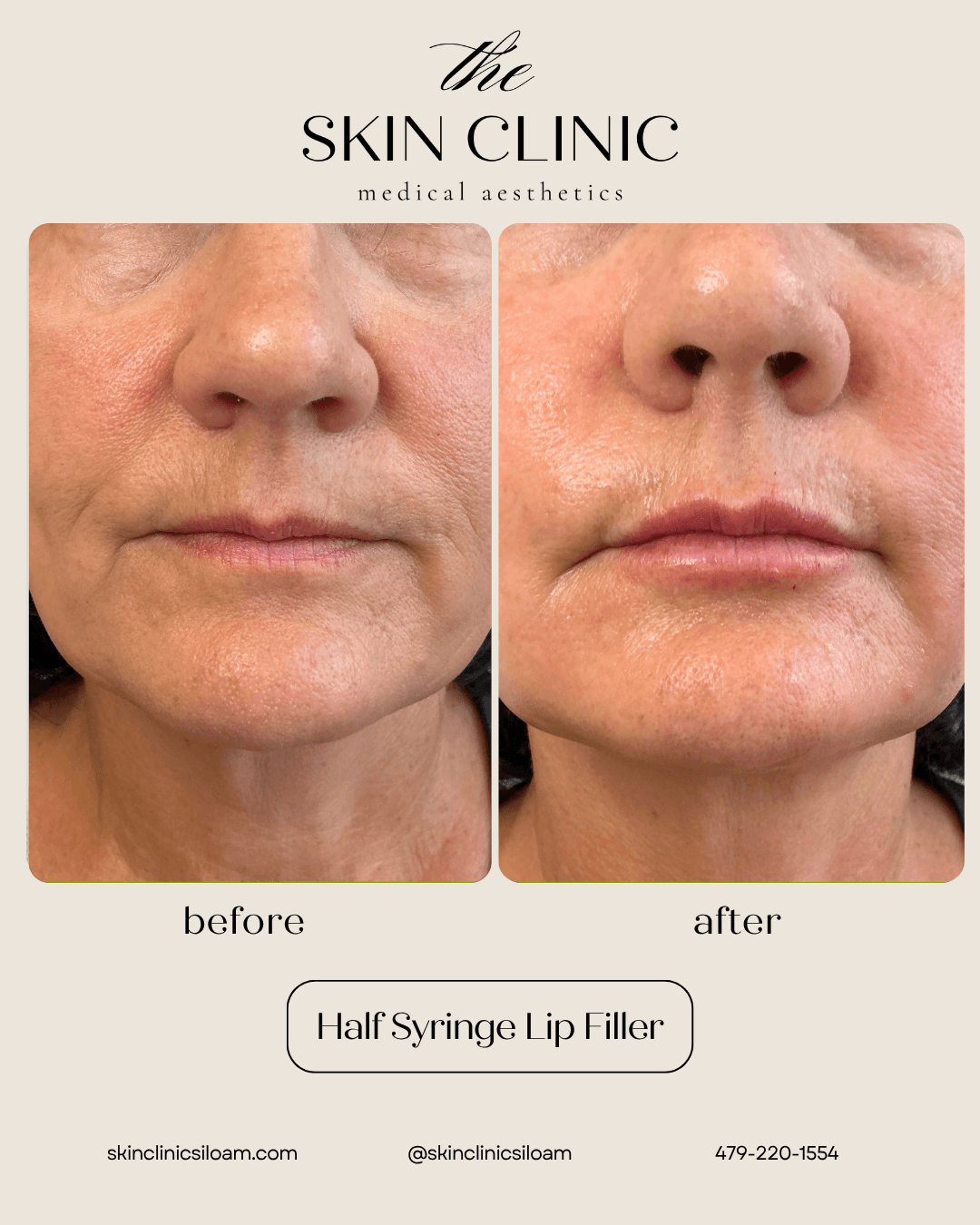 Half Syringe Lip Filler - Before & After