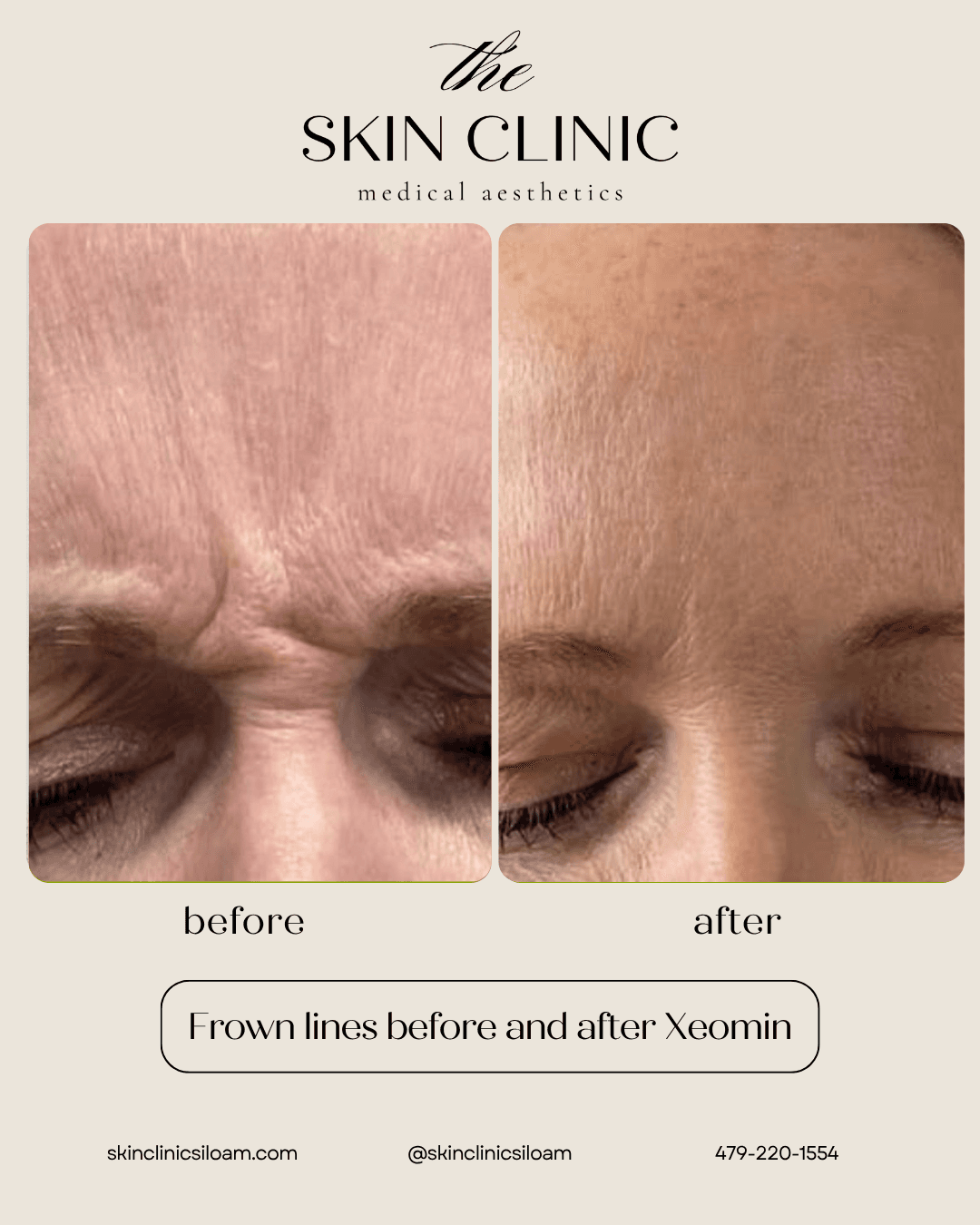 Frown Lines Xeomin - Before & After