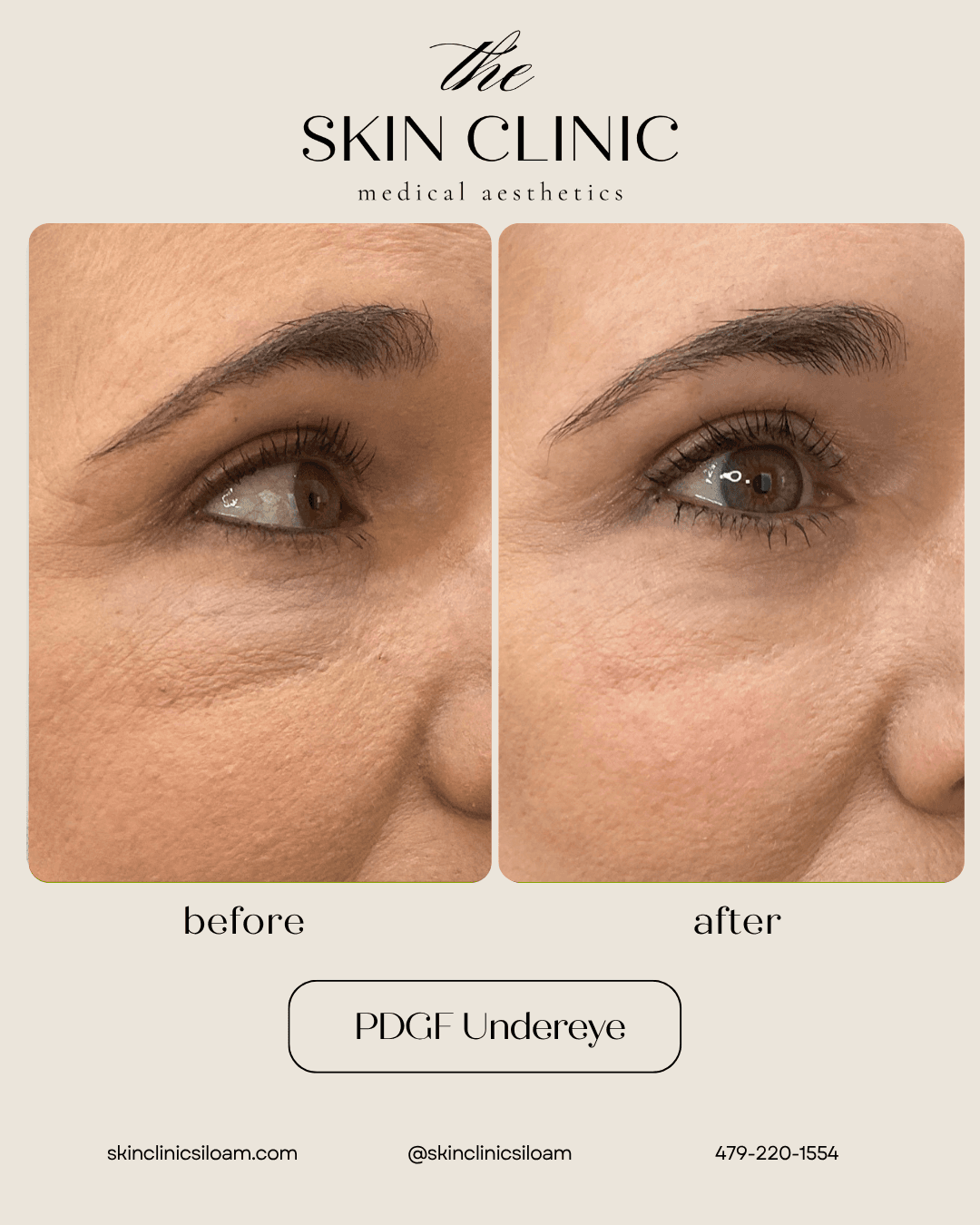 PDGF Undereye - Before & After