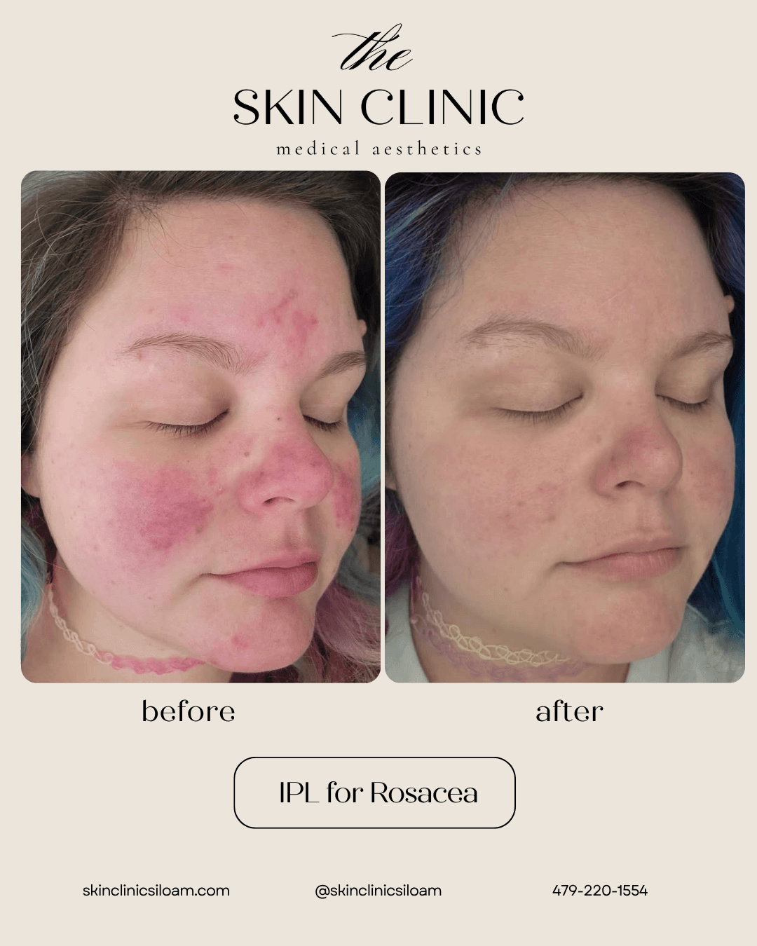 IPL for Rosacea - Before & After