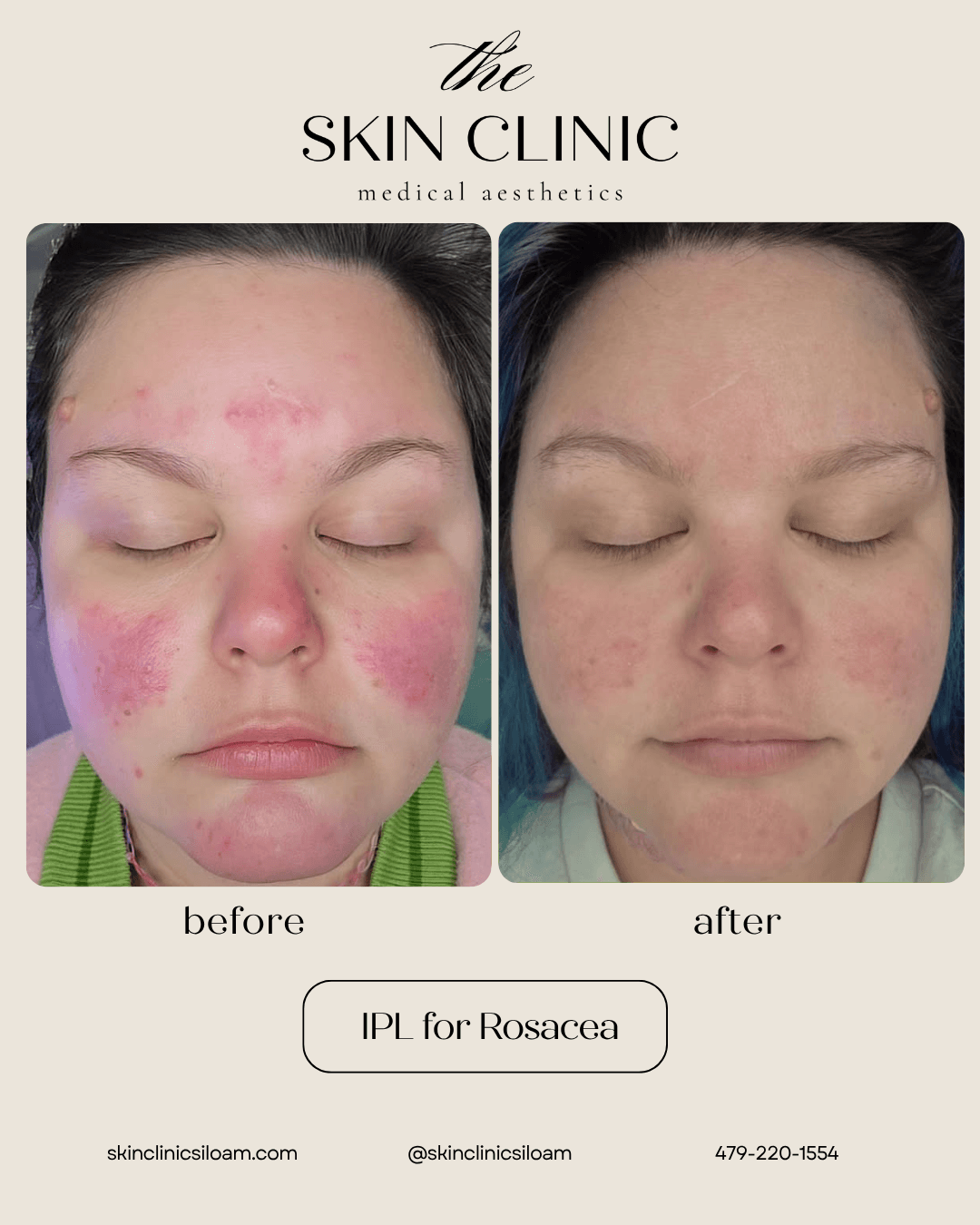 IPL for Rosacea - Before & After