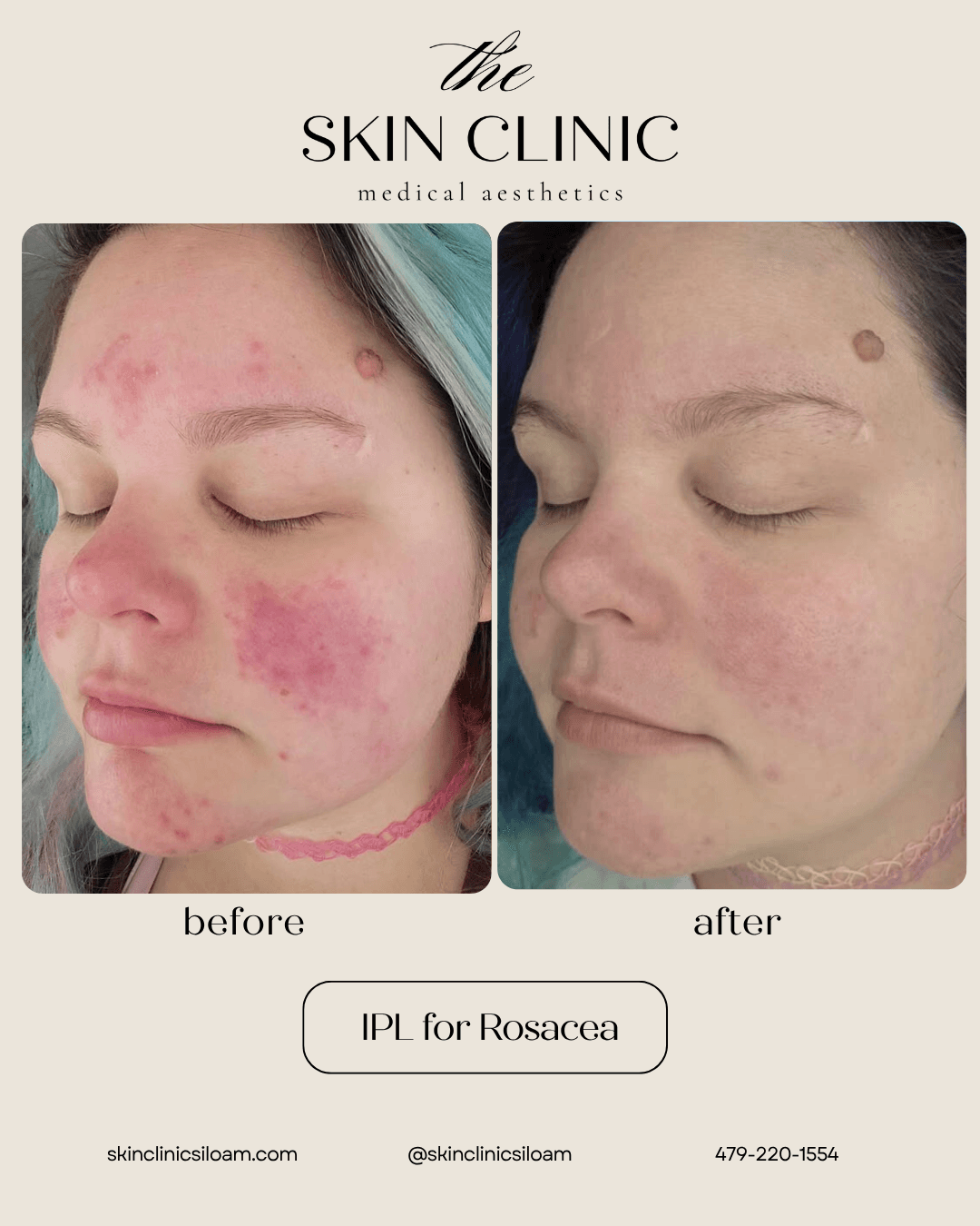 IPL for Rosacea - Before & After