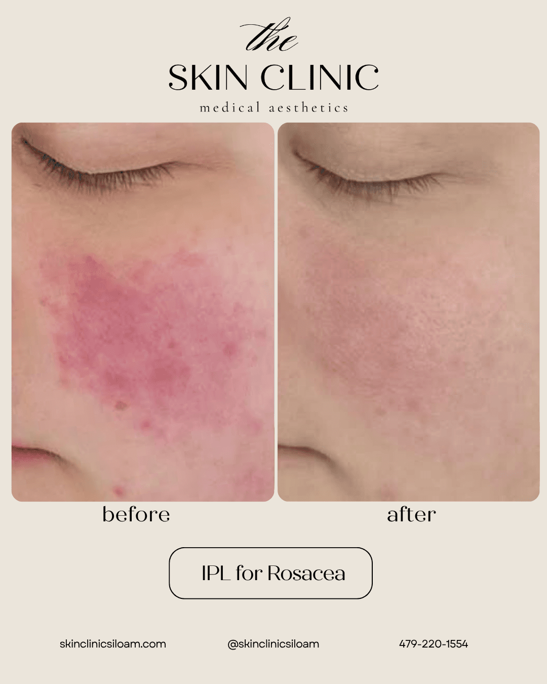 IPL for Rosacea - Before & After
