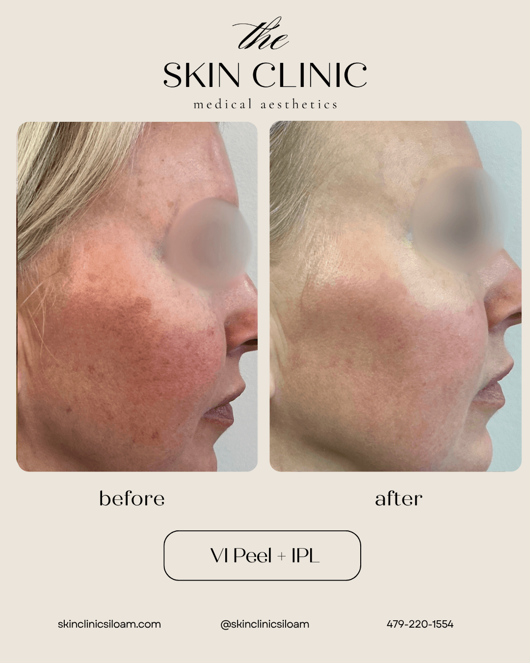 VI Peel + IPL - Before & After