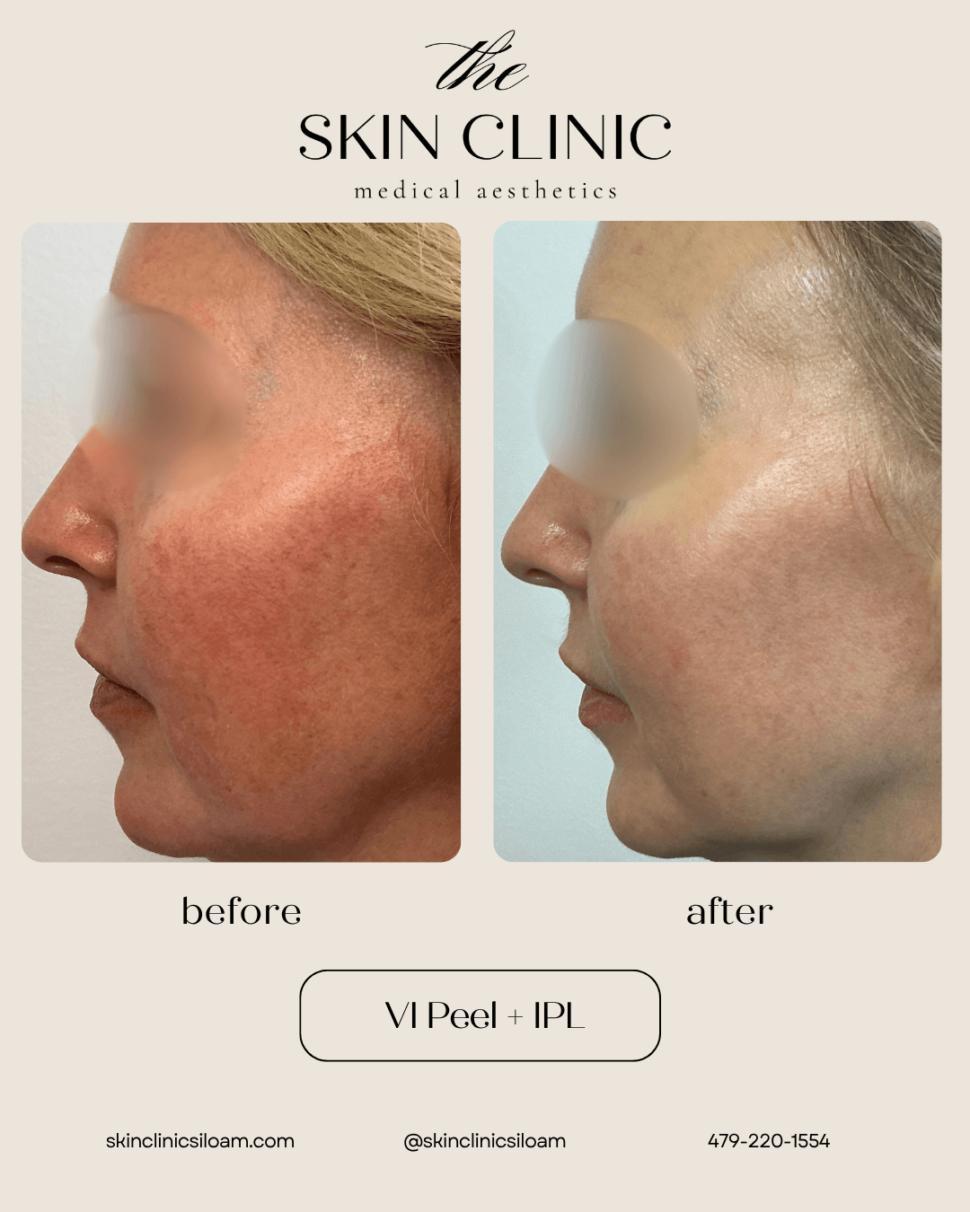 VI Peel + IPL - Before & After