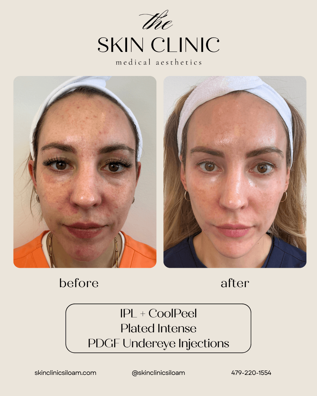 Kysse Lip Filler - Before & After