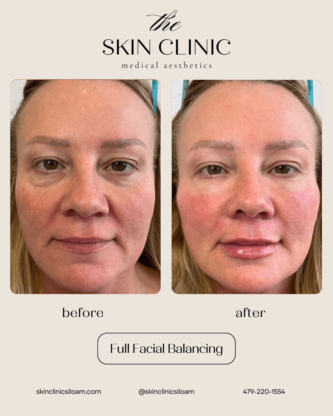 Full Facial Balancing - Before & After