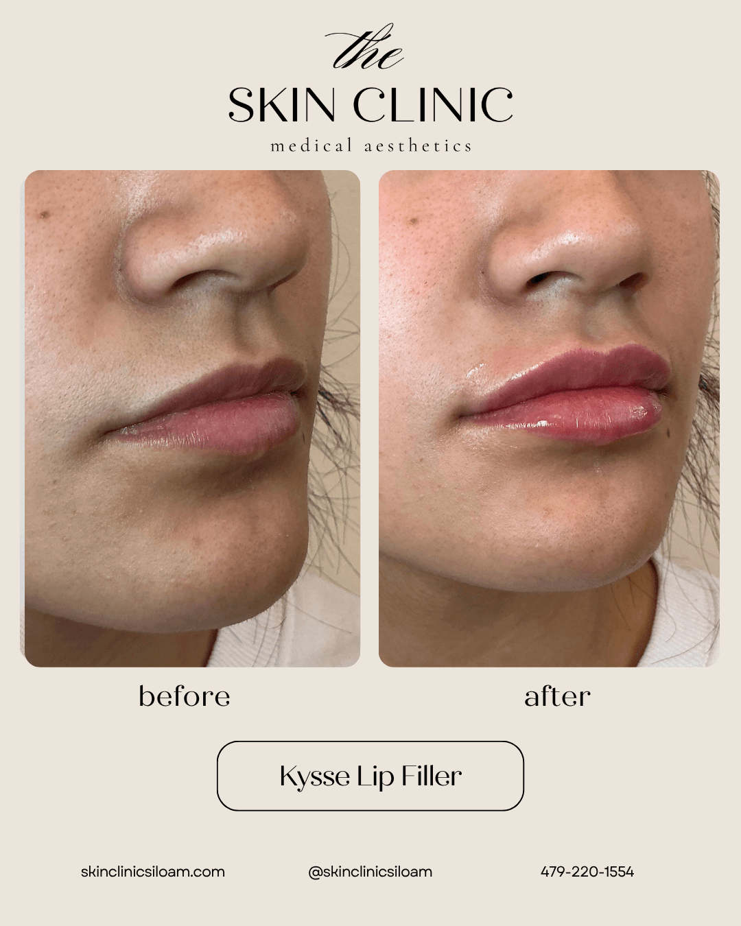 Kysse Lip Filler - Before & After