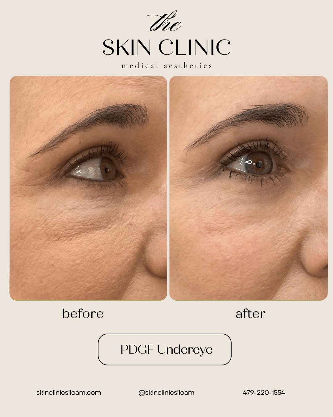 PDGF Undereye - Before & After