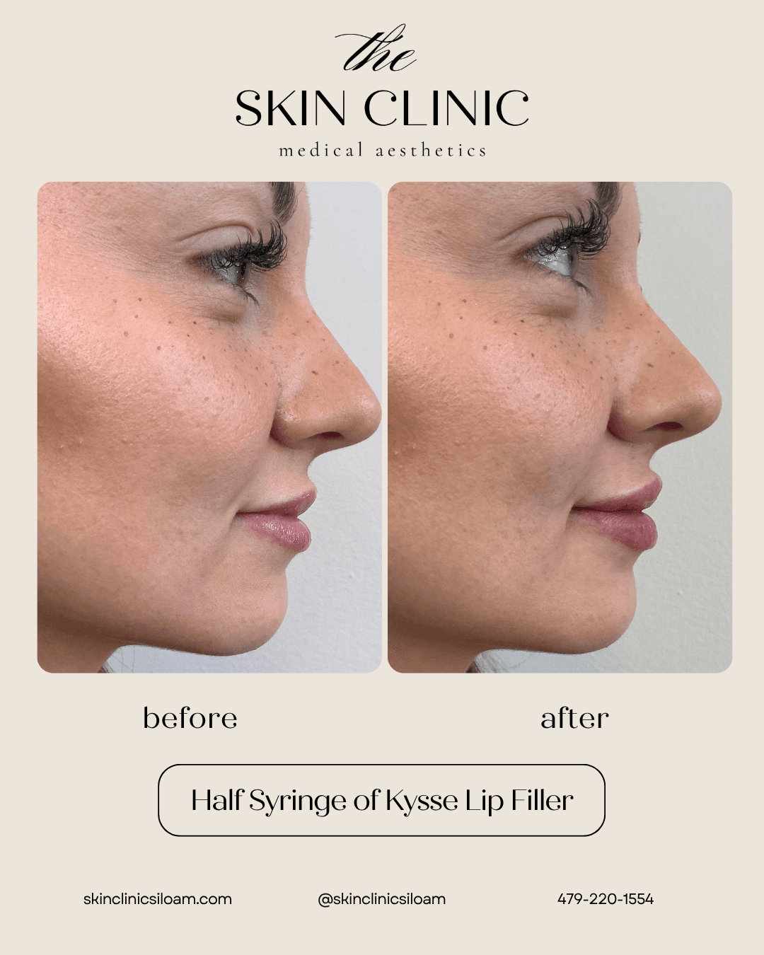 Kysse Lip Filler - Before & After
